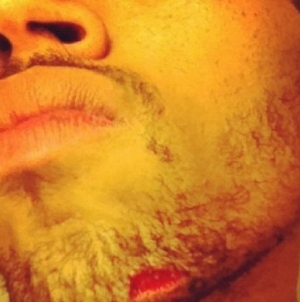 Chris Brown Bleeds After Fight With Drake